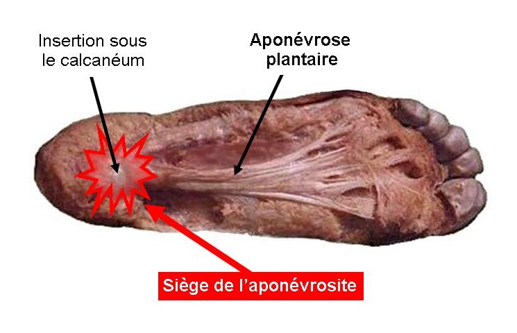 Semelles pour aponévrosite discount plantaire